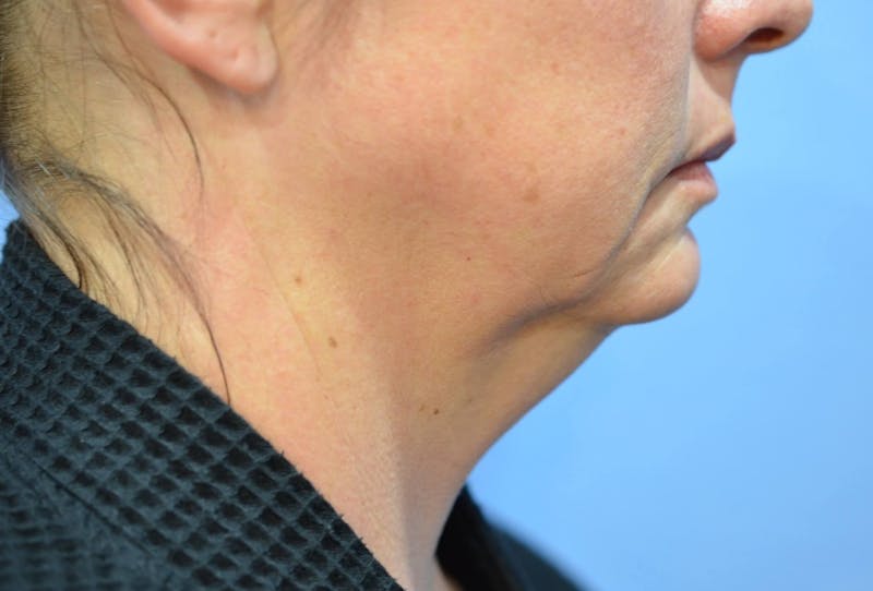 FaceTite Before and After Before & After Gallery - Patient 735186 - Image 1
