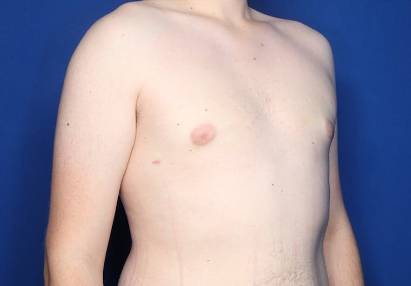 Gynecomastia (Male Breast Reduction) Before & After Gallery - Patient 255688 - Image 6