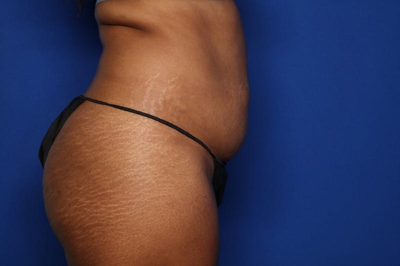 Liposuction Before & After Gallery - Patient 297940 - Image 3