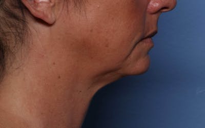FaceTite Before and After Before & After Gallery - Patient 735186 - Image 2