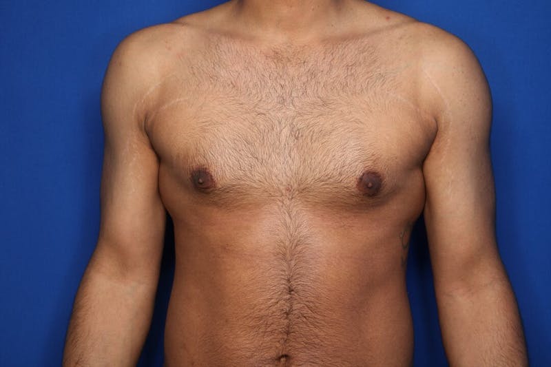Gynecomastia (Male Breast Reduction) Before & After Gallery - Patient 255772 - Image 1