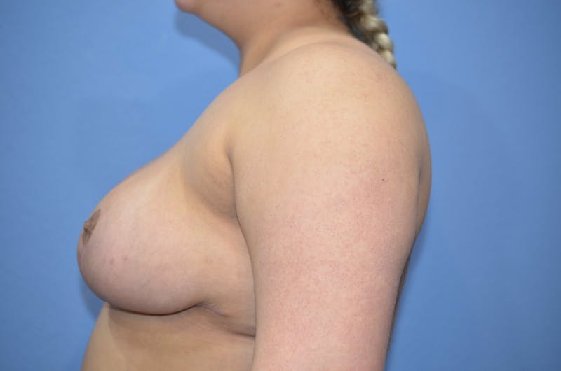 Breast Reduction Before & After Gallery - Patient 351676 - Image 4