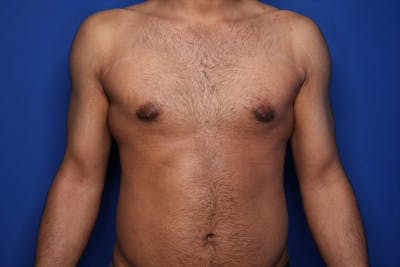 Gynecomastia (Male Breast Reduction) Before & After Gallery - Patient 255772 - Image 2