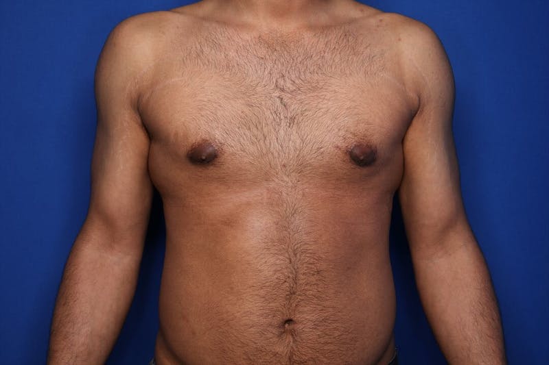 Gynecomastia (Male Breast Reduction) Before & After Gallery - Patient 255772 - Image 2