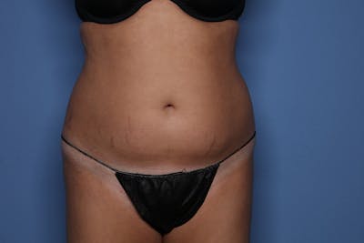 BodyTite™ Before & After Gallery - Patient 889694 - Image 1