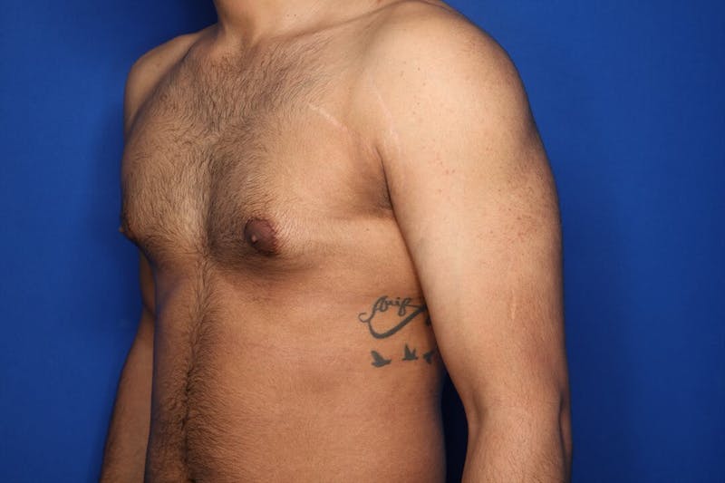Gynecomastia (Male Breast Reduction) Before & After Gallery - Patient 255772 - Image 3