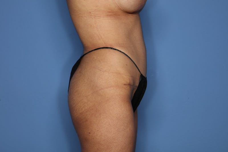 Breast Revision Before & After Gallery - Patient 335713 - Image 8