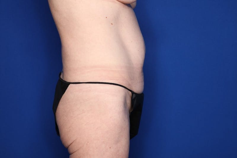 Tummy Tuck Before & After Gallery - Patient 416317 - Image 5