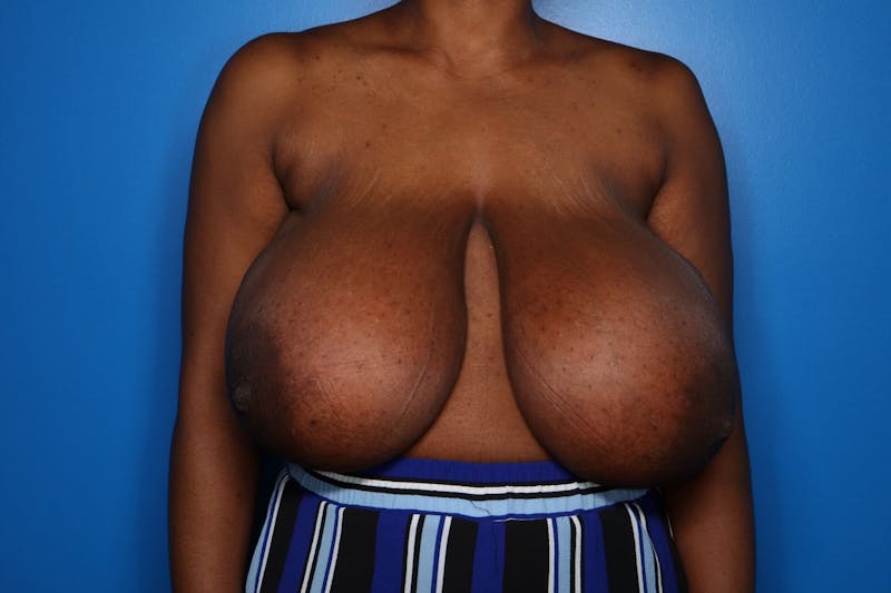 Breast Reduction Before & After Gallery - Patient 285343 - Image 1