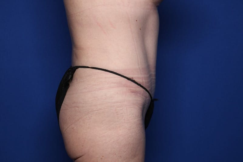 Tummy Tuck Before & After Gallery - Patient 416317 - Image 6
