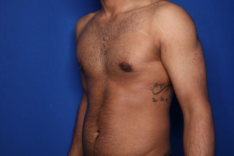 Gynecomastia (Male Breast Reduction) Before & After Gallery - Patient 255772 - Image 4