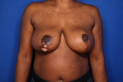 Breast Reduction Before & After Gallery - Patient 285343 - Image 2