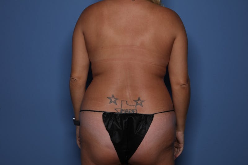 BodyTite™ Before & After Gallery - Patient 889694 - Image 3