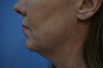 FaceTite Before and After Before & After Gallery - Patient 353382 - Image 1