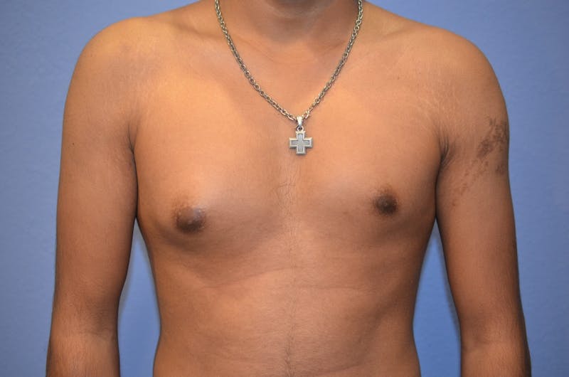 Gynecomastia (Male Breast Reduction) Before & After Gallery - Patient 113183 - Image 1