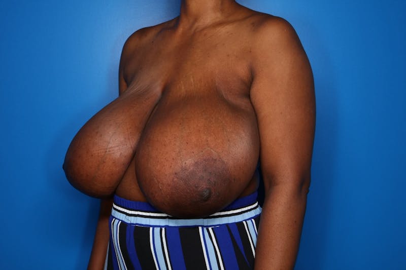 Breast Reduction Before & After Gallery - Patient 285343 - Image 3