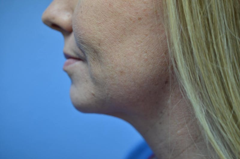 FaceTite™ Before & After Gallery - Patient 353382 - Image 2