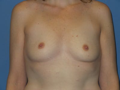 Breast Augmentation Before & After Gallery - Patient 724230 - Image 1