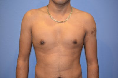 Gynecomastia (Male Breast Reduction) Before & After Gallery - Patient 113183 - Image 2