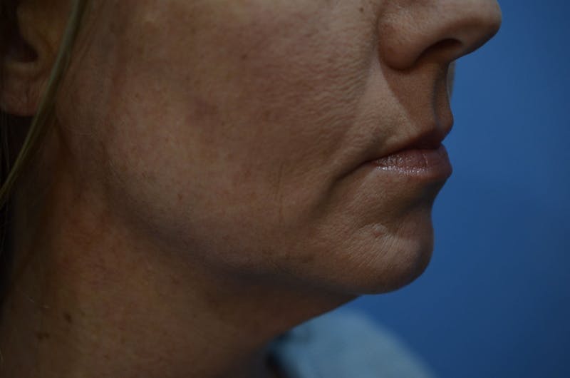 FaceTite Before and After Before & After Gallery - Patient 353382 - Image 3