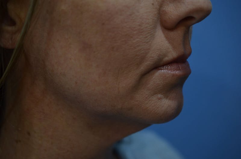 FaceTite™ Before & After Gallery - Patient 353382 - Image 3