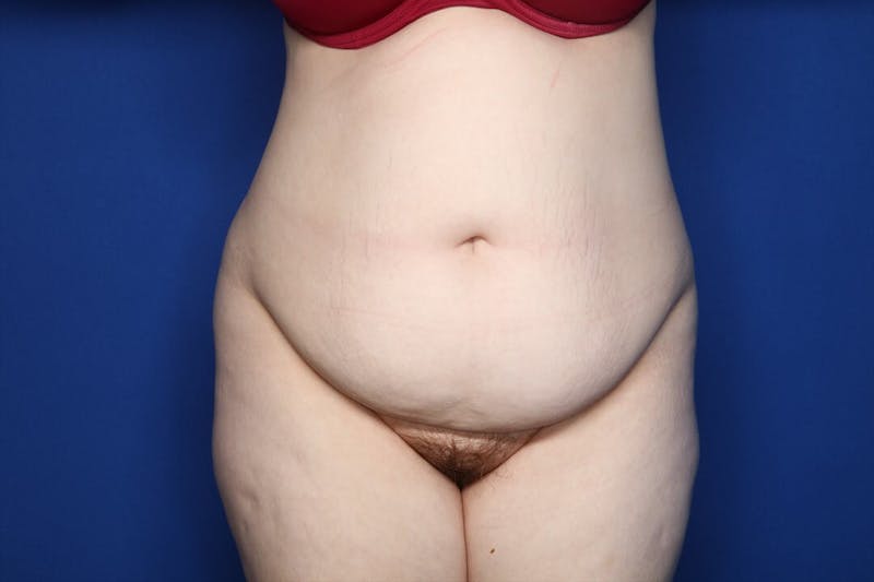 Tummy Tuck Before & After Gallery - Patient 311766 - Image 1