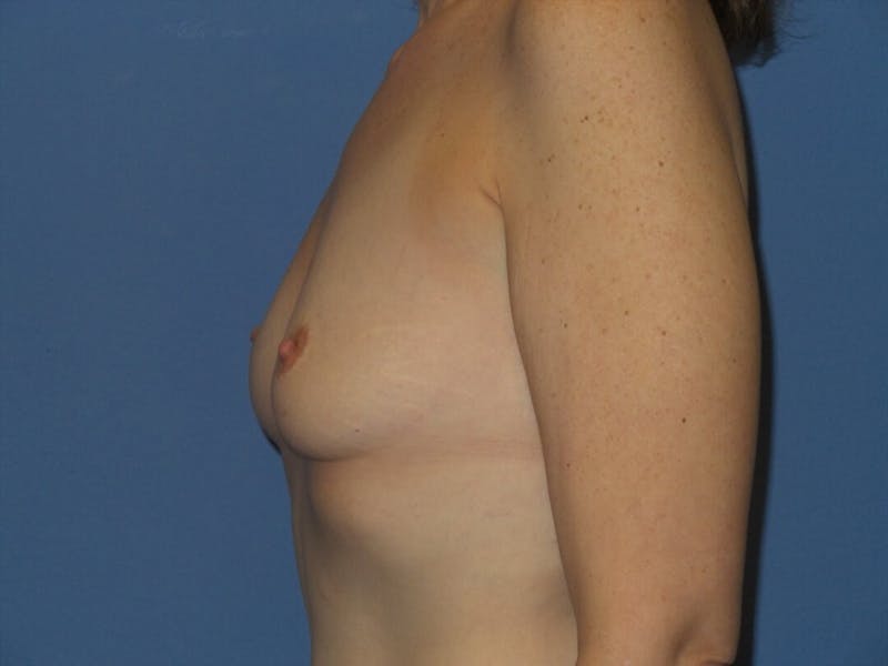 Breast Augmentation Before & After Gallery - Patient 724230 - Image 3