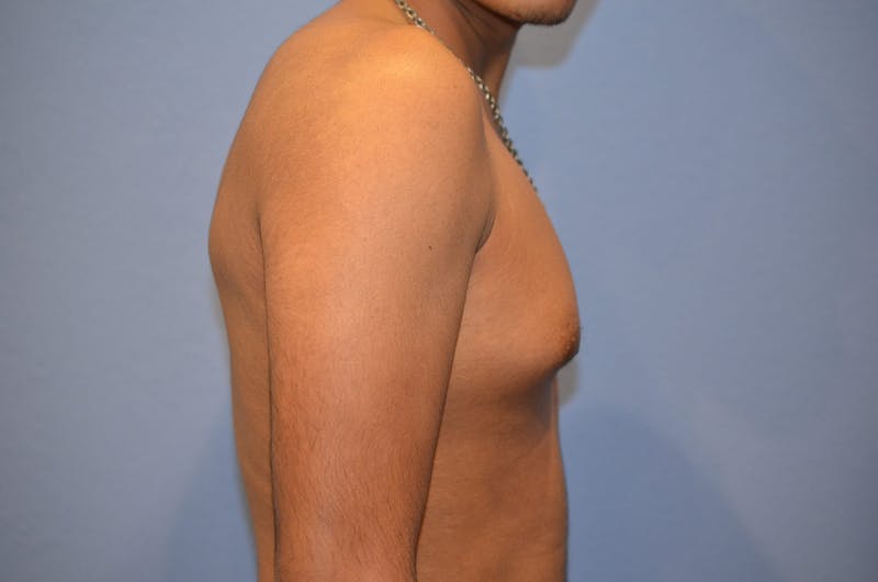 Gynecomastia (Male Breast Reduction) Before & After Gallery - Patient 113183 - Image 3