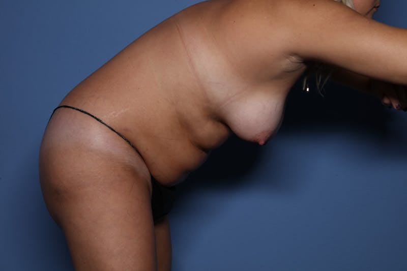 BodyTite™ Before and After Before & After Gallery - Patient 889694 - Image 7