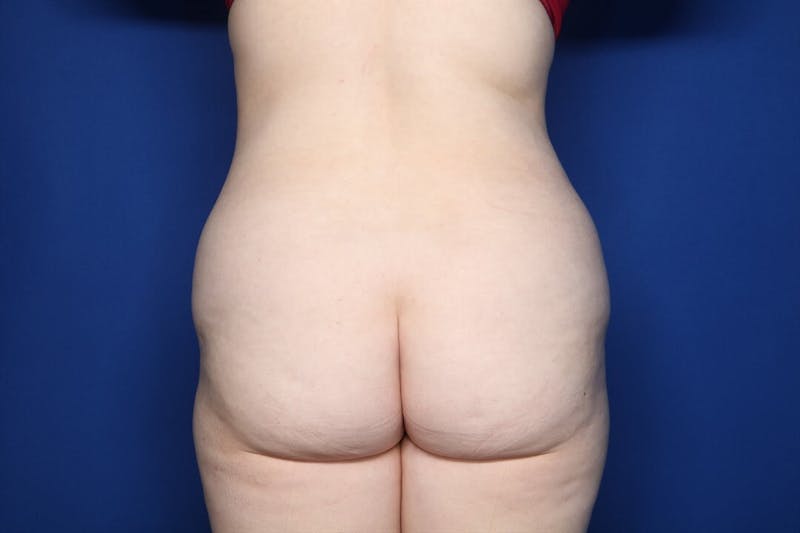 Tummy Tuck Before & After Gallery - Patient 311766 - Image 3