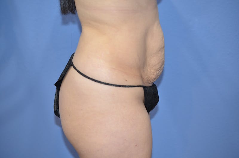 Mommy Makeover Before & After Gallery - Patient 121028 - Image 3