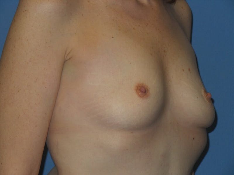 Breast Augmentation Before & After Gallery - Patient 724230 - Image 5