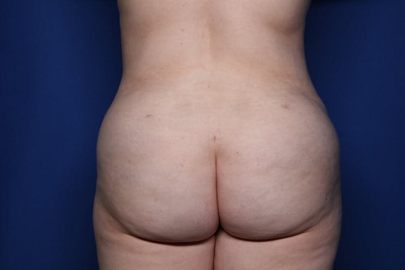 Tummy Tuck Before & After Gallery - Patient 311766 - Image 4