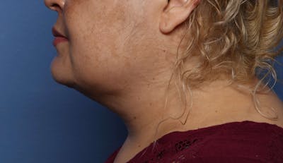 FaceTite Before & After Gallery - Patient 322350 - Image 2