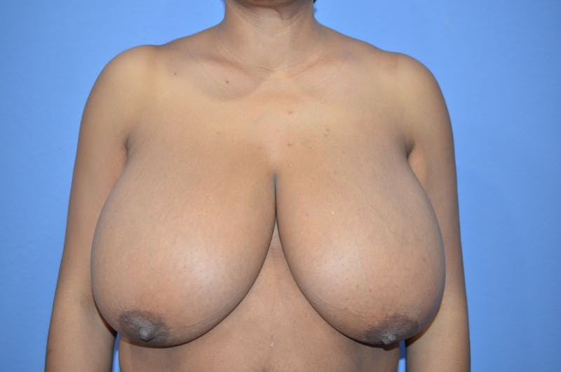 Breast Reduction Before & After Gallery - Patient 181531 - Image 1