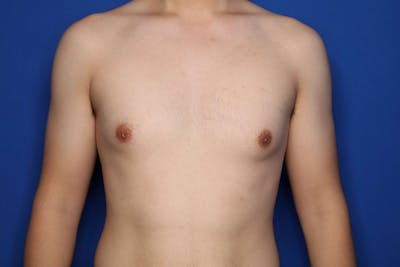 Gynecomastia (Male Breast Reduction) Before & After Gallery - Patient 308391 - Image 1