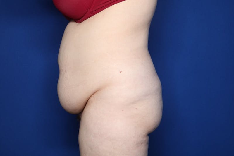 Tummy Tuck Before & After Gallery - Patient 311766 - Image 5