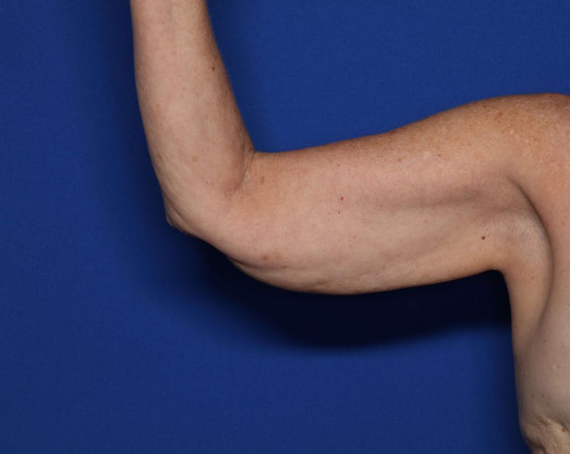 BodyTite™ Before and After Before & After Gallery - Patient 204795 - Image 1