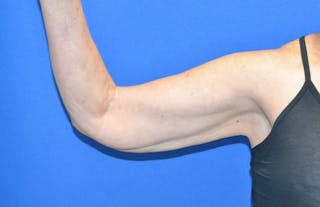 BodyTite™ Before and After Before & After Gallery - Patient 204795 - Image 2