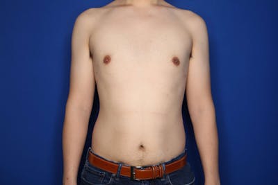 Gynecomastia (Male Breast Reduction) Before & After Gallery - Patient 308391 - Image 2