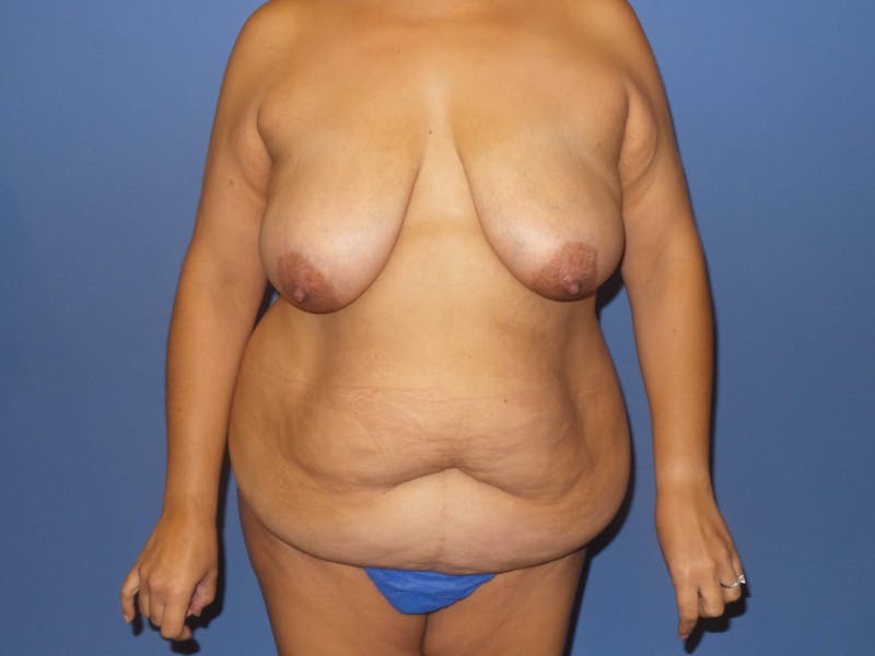 Breast Lift Before & After Gallery - Patient 312190 - Image 1