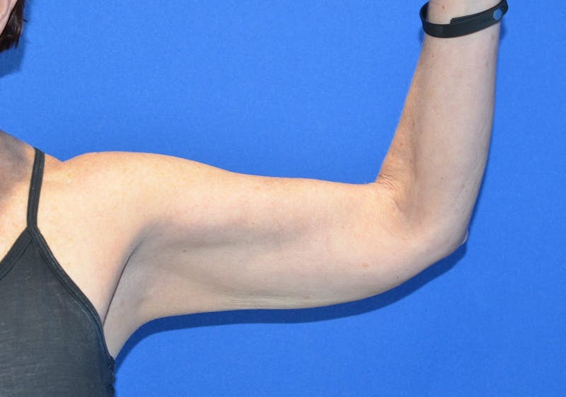 BodyTite™ Before and After Before & After Gallery - Patient 204795 - Image 4