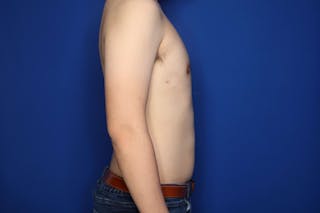 Gynecomastia (Male Breast Reduction) Before & After Gallery - Patient 308391 - Image 4