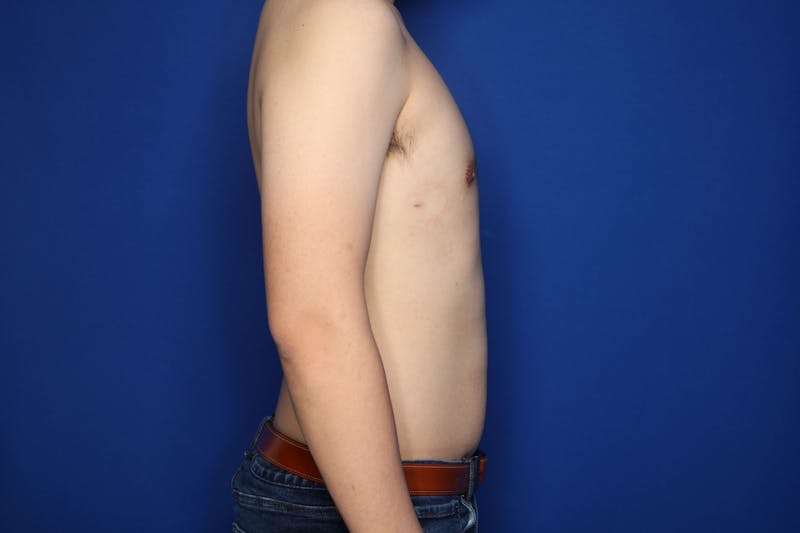 Gynecomastia (Male Breast Reduction) Before & After Gallery - Patient 308391 - Image 4
