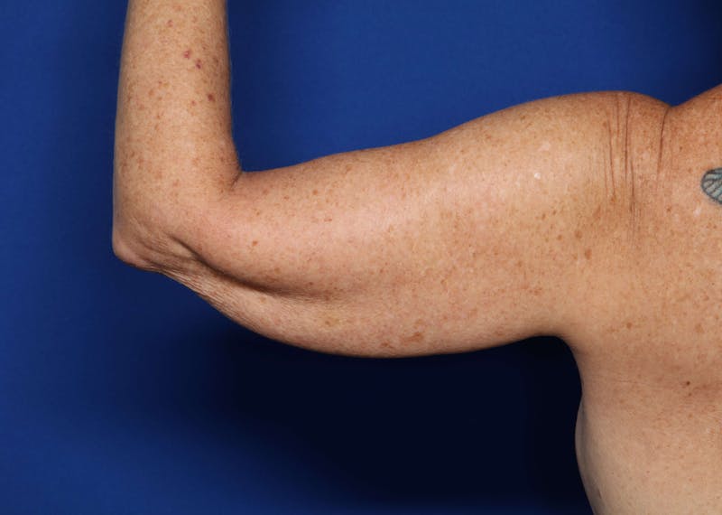 BodyTite™ Before and After Before & After Gallery - Patient 204795 - Image 5