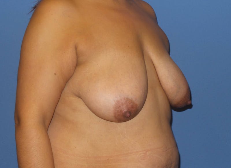 Breast Lift Before & After Gallery - Patient 312190 - Image 5