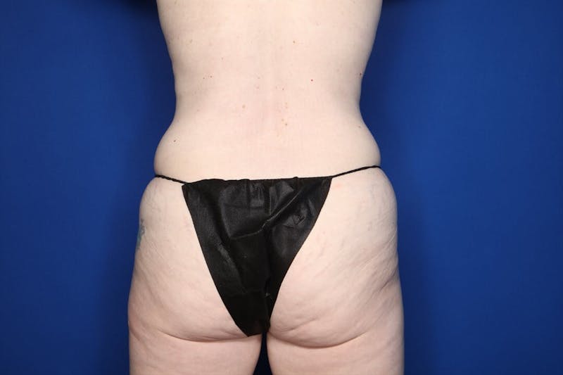 Tummy Tuck Before & After Gallery - Patient 281848 - Image 7