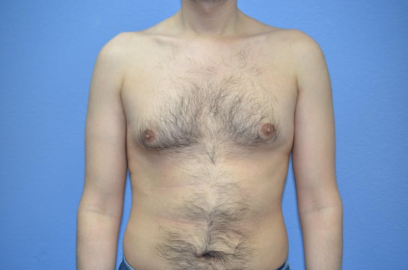 Gynecomastia (Male Breast Reduction) Before & After Gallery - Patient 239296 - Image 1