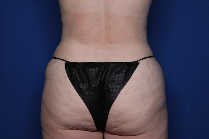 Tummy Tuck Before & After Gallery - Patient 281848 - Image 8