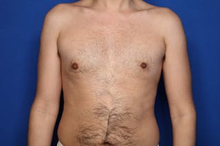 Gynecomastia (Male Breast Reduction) Before & After Gallery - Patient 239296 - Image 2